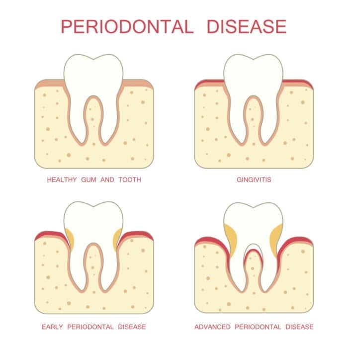 periodontal disease chart rockville md dentist