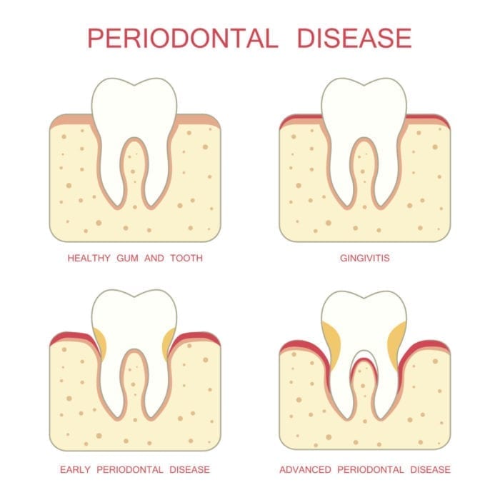 treat bleeding gums in rockville, maryland