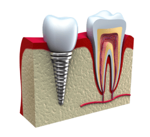 dental implant procedure in Rockville MD