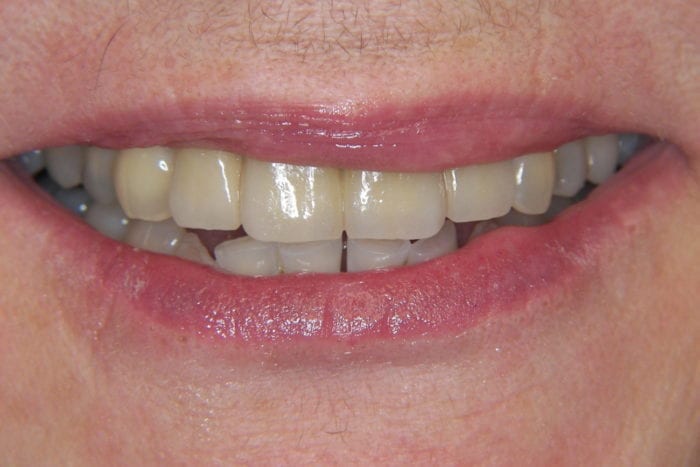 After dental implants at Congressional Dental Care