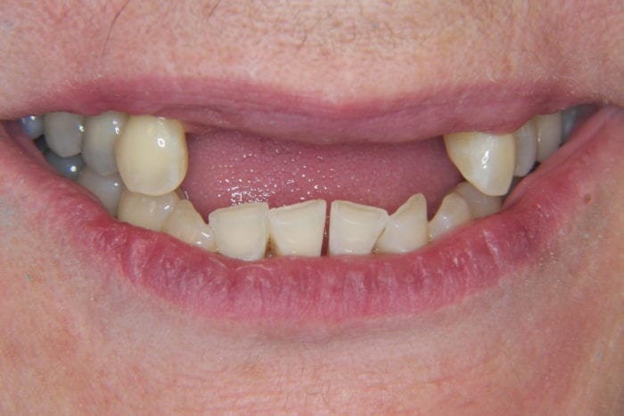 before dental implants at Congressional Dental Care