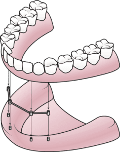 affordable Dentures in Rockville, Maryland