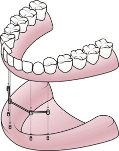 affordable Dentures in Rockville, MD