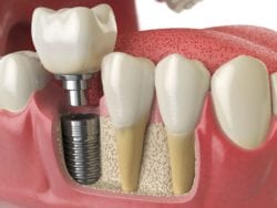 cheap dental implants in Rockville, Maryland