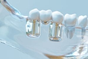 getting multiple dental implants in rockville, maryland