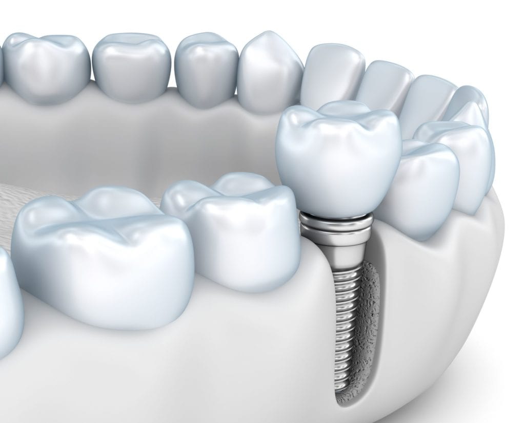 dental implants and jawbone health in Rockville Maryland