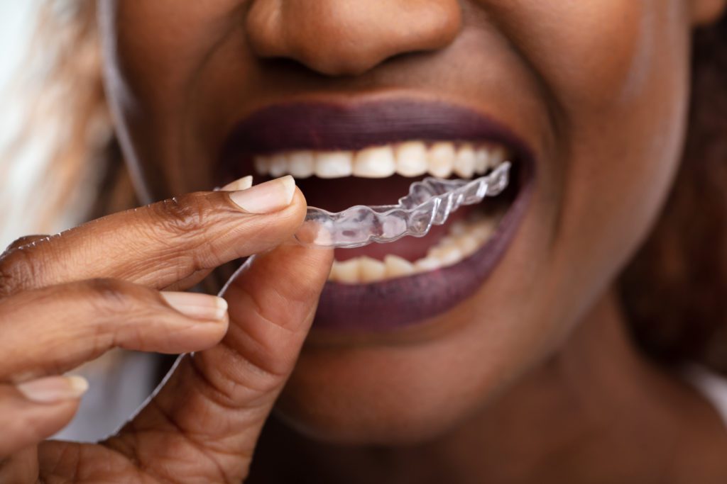 Invisalign treatment in Rockville, Maryland