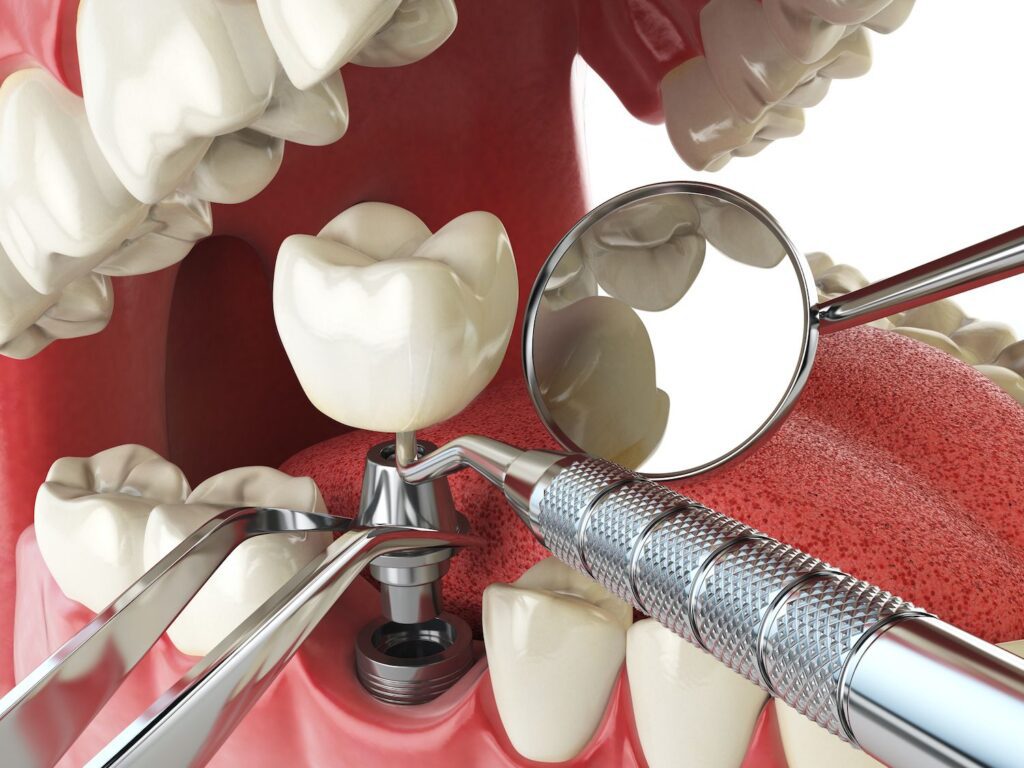 implant dentistry recovery