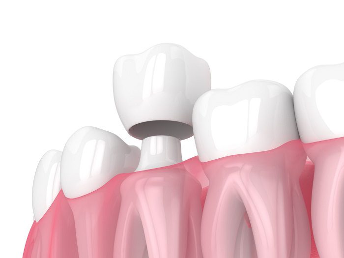 How Long Will a Dental Crown Last
