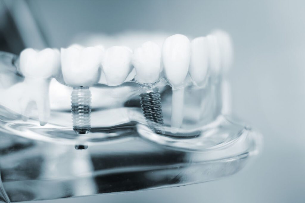 Implant dentistry involves the placement of artificial tooth roots, which serve as a stable foundation for fixed replacement teeth.