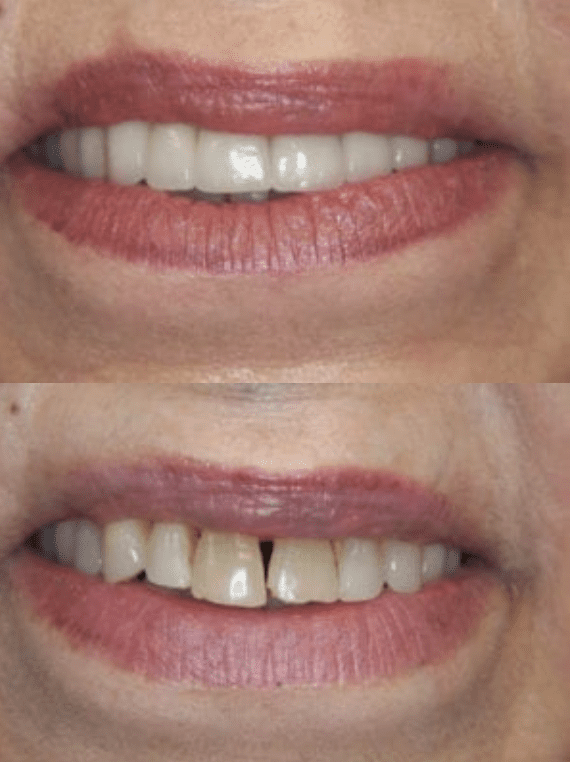 before and after a smile makeover in rockville, md