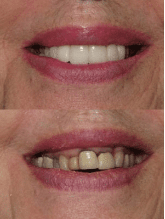before and after dental crown treatment in rockville, maryland