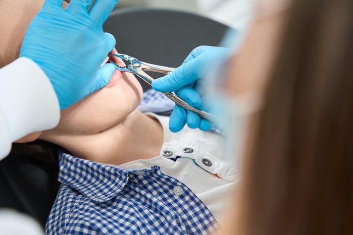 tooth extraction in rockville, maryland